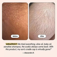 Tubby Todd Bye-Bye Cradle Cap Gel 1.8 fl oz (Pack of 1) - Soothing Treatment for Baby Scalp Care with Aloe Vera and Olive Fruit Oil