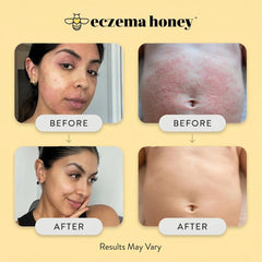 ECZEMA HONEY Original Skin-Soothing Cream for Dry Itchy Skin (4 Oz)